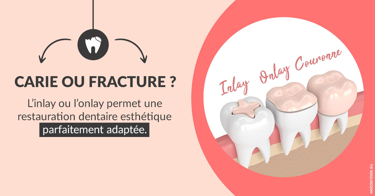 https://dr-decroos-sylvie.chirurgiens-dentistes.fr/T2 2023 - Carie ou fracture 2