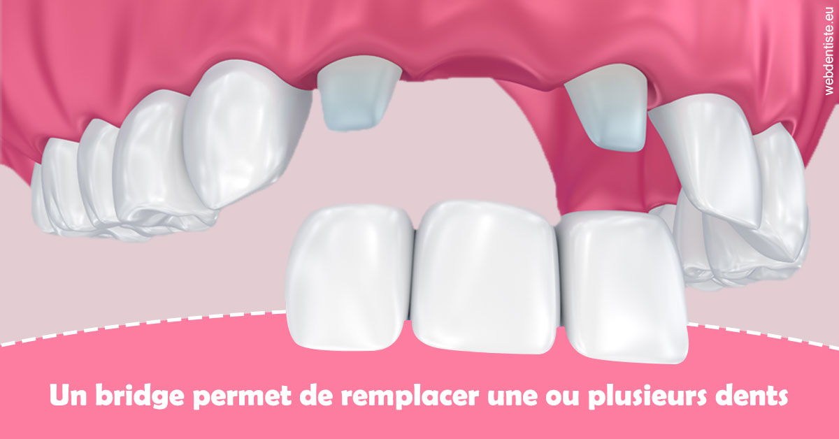 https://dr-decroos-sylvie.chirurgiens-dentistes.fr/Bridge remplacer dents 2