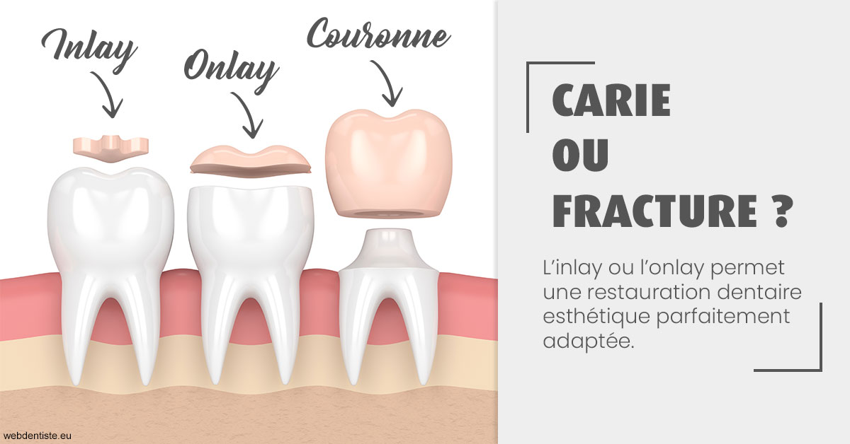 https://dr-decroos-sylvie.chirurgiens-dentistes.fr/T2 2023 - Carie ou fracture 1