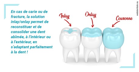 https://dr-decroos-sylvie.chirurgiens-dentistes.fr/L'INLAY ou l'ONLAY