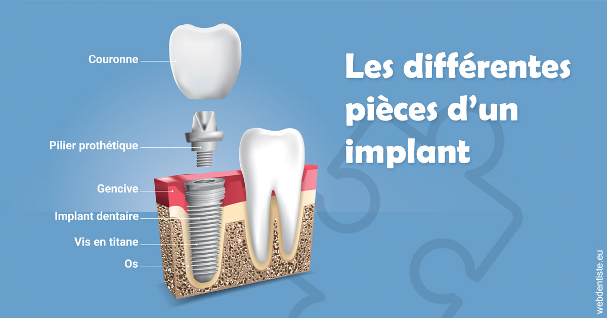 https://dr-decroos-sylvie.chirurgiens-dentistes.fr/Les différentes pièces d’un implant 1